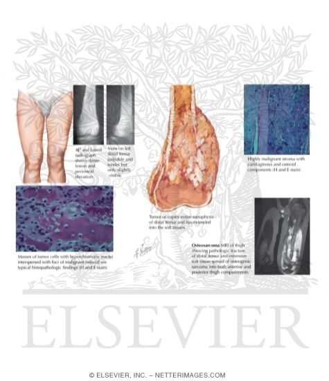 Watermarked preview of labeled image: Osteosarcoma