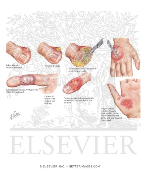 Watermarked preview of labeled image: Cellulitis and Epidermal Abscess