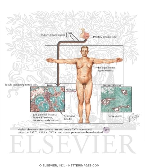 Testicular Failure - Seminiferous Tubular Dysgenesis (Klinefelter's Syndrome)