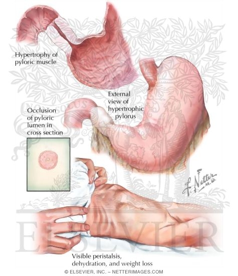 Watermarked preview of labeled image: Hypertrophic Pyloric Stenosis