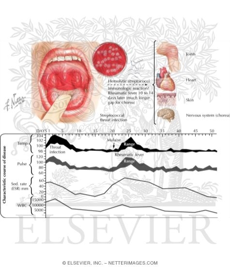 Rheumatic Fever; Sydenham's Chorea