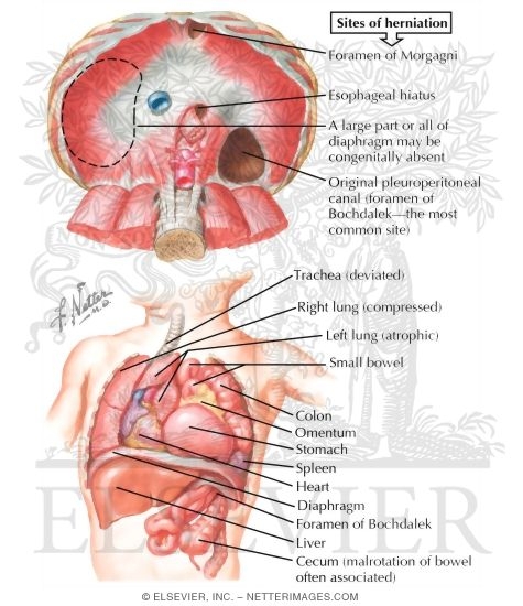 Congenital Diaphragmatic Hernia