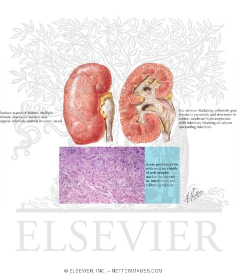 Acute Pyelonephritis: Pathology
