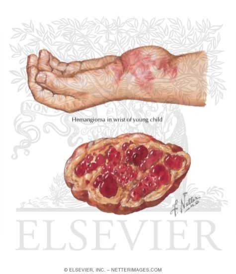 Hemangioma