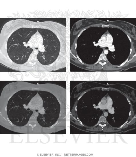 The Hounsfield Scale: CT Window Levels and Window Widths