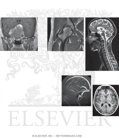 MRI Uses, Advantages and Disadvantages