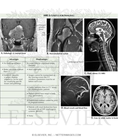 MRI Uses, Advantages and Disadvantages