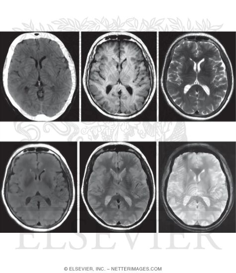 MRI Pulse Sequences