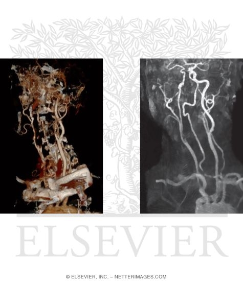 Watermarked preview of unlabeled image: Angiography: Computed Tomography Angiogram Vs. Magnetic Resonance Angiogram and Volume Rendering Vs. Maximum Intensity Projection