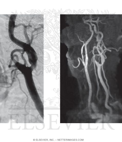 Angiography: Digital Subtraction Angiography