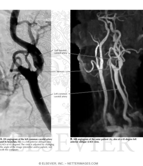 Angiography: Digital Subtraction Angiography