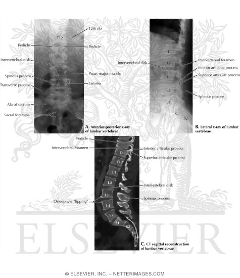 Lumbar Vertebrae Images (AP and Lateral Lumbar X-Rays With CT Sagittal Reconstruction)
