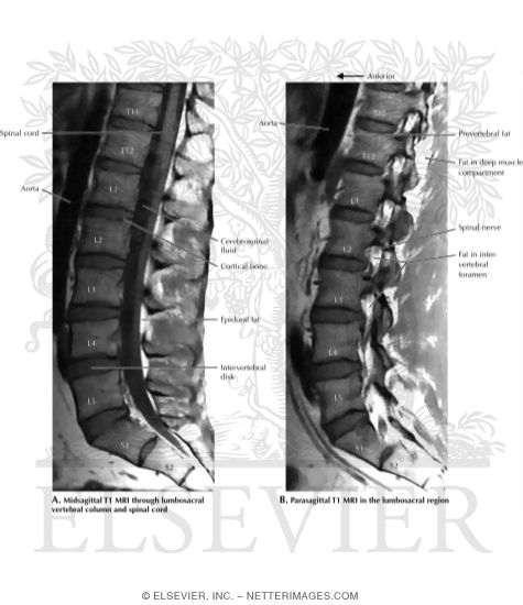 Watermarked preview of labeled image: Normal T1 MRI Studies of the Lumbar Vertebral Column