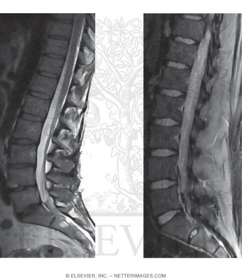 T2 and Fat Saturation MRI Sequences