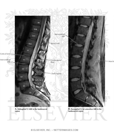 T2 and Fat Saturation MRI Sequences