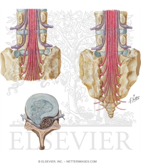 Lumbar Disc Herniation