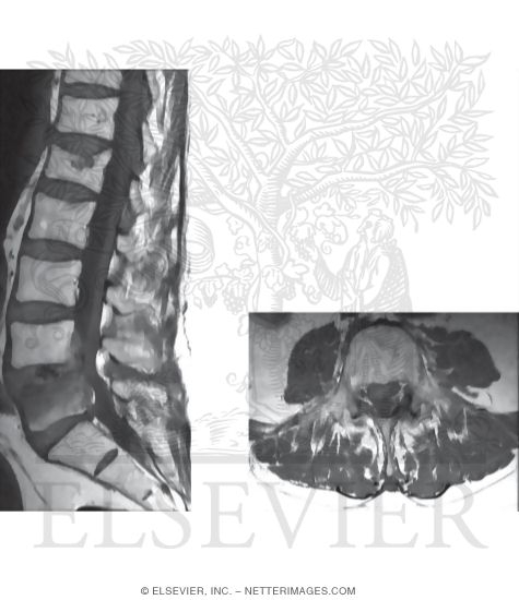 MRI of a Herniated Disc