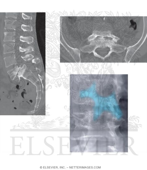 MRI of Spondylolisthesis