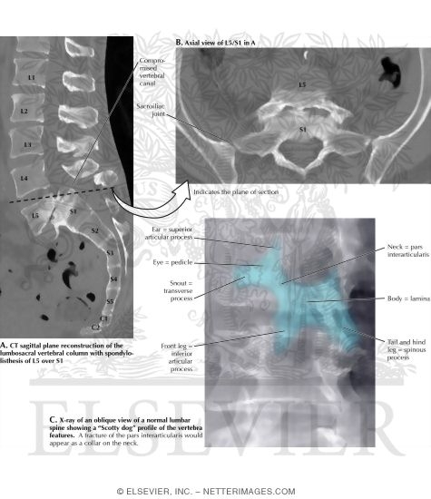 MRI of Spondylolisthesis