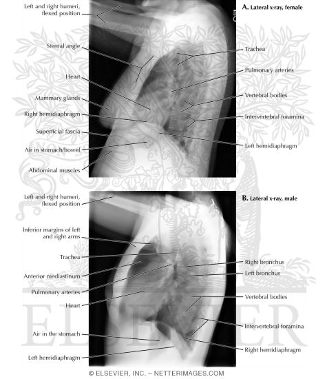 Lateral Chest X-Ray