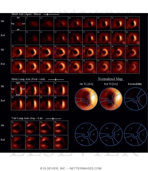 Watermarked preview of unlabeled image: Single-Photon Emission Computed Tomography (SPECT)