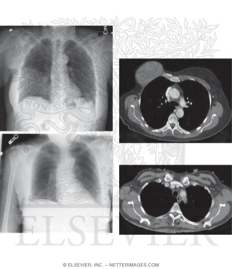 Watermarked preview of unlabeled image: Search Strategy: Thoracic Wall Soft Tissues (Air, Calcification, Foreign Bodies, Etc.)