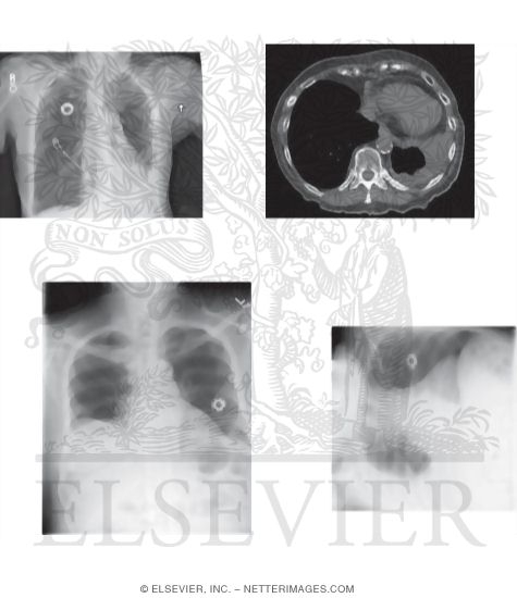 Watermarked preview of unlabeled image: Search Strategy: Pleural Spaces and Diaphragm