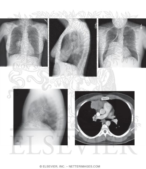 Search Strategy: Mediastinum and Hila