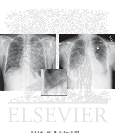 Search Strategy: Lungs, Alveolar Vs. Interstitial Opacity