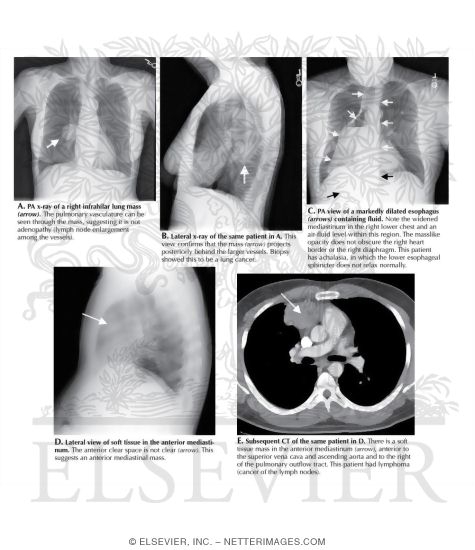 Search Strategy: Mediastinum and Hila