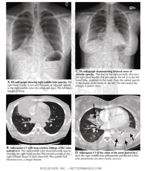 Search Strategy: Lungs – Silhouette Sign