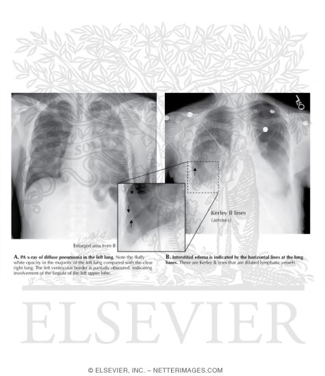 Search Strategy: Lungs, Alveolar Vs. Interstitial Opacity