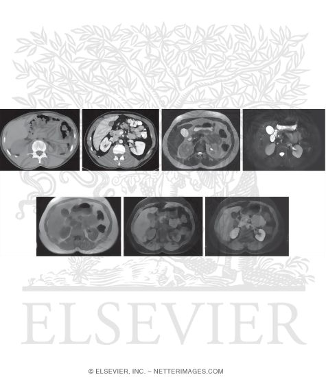 CT Vs. MRI In Abdominal Studies