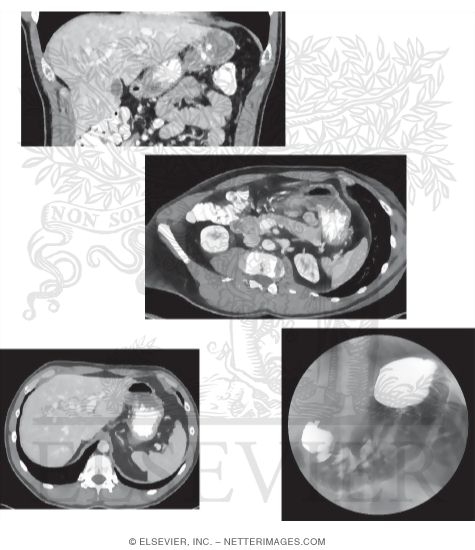 Upper GI CT Studies