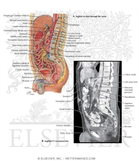Sagittal Section Through Aorta With CT Sagittal Reconstruction