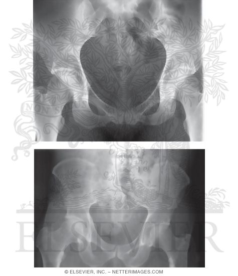 Female and Male Pelvis X-Rays