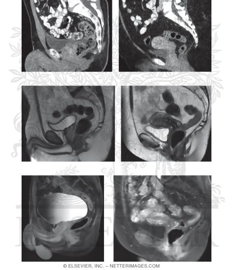 CT Vs. MRI in the Pelvis