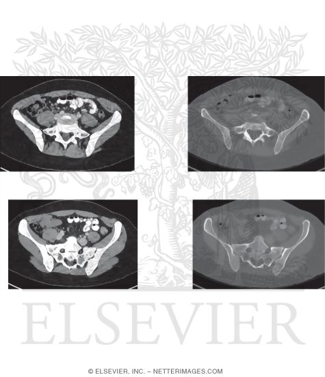 Image Search Strategy in the Upper Female Pelvis