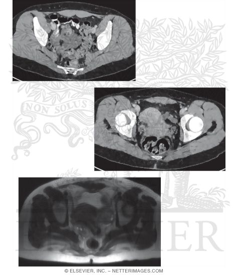 Image Search Strategy in the Lower Female Pelvis