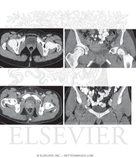 Axial and Coronal CT of Bladder Relationships