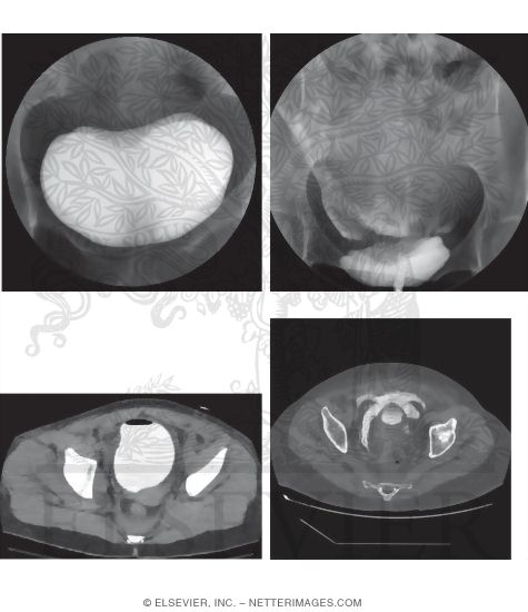 Cystogram