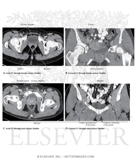 Watermarked preview of labeled image: Axial and Coronal CT of Bladder Relationships