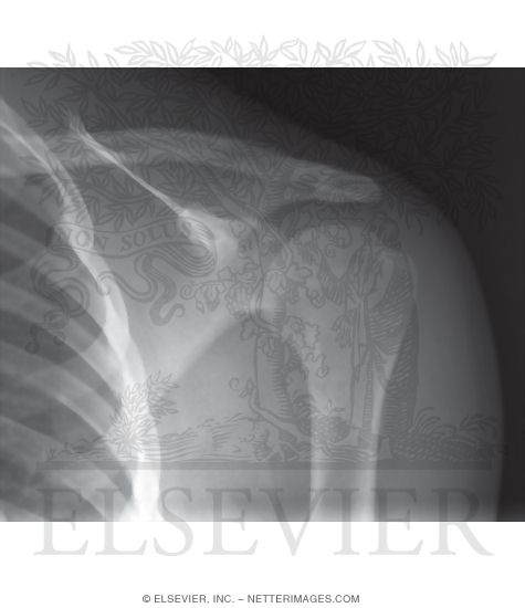 Anterior-Posterior Shoulder X-Ray (AP Radiograph of the Shoulder)
