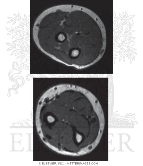 Upper and Middle Forearm MRI 
