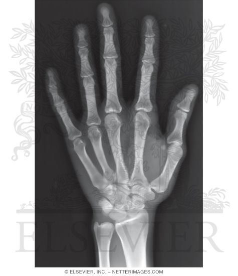 Anteroposterior Radiograph of the Wrist and Hand