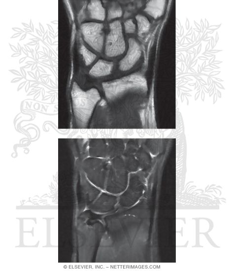 T1 and T2 MRI of the Wrist Joint
