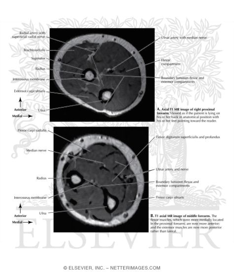 Upper and Middle Forearm MRI 