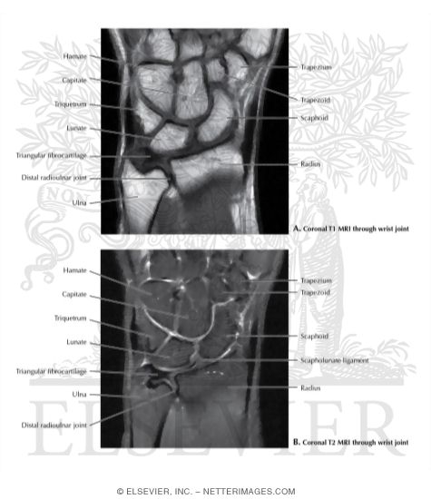T1 and T2 MRI of the Wrist Joint