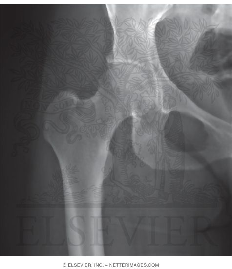 Hip Joint: X-Ray