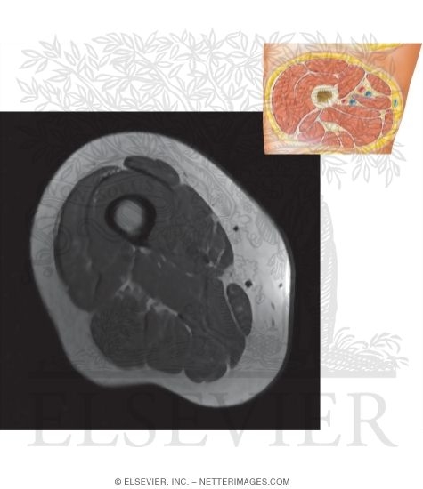 Middle Right Thigh T1 MRI